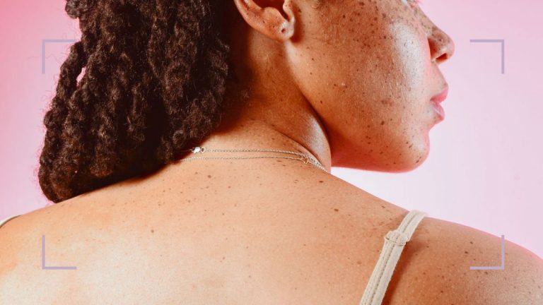 Dermem schválené ošetření hyperpigmentace, které opravdu funguje